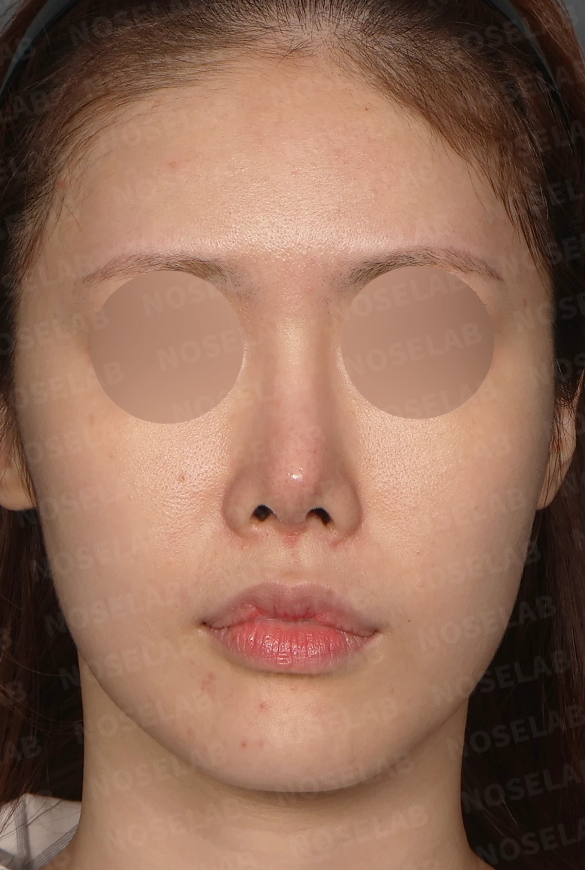 보형물 비침과 비대칭, 자가늑연골 코재수술로 자연스럽게 교정한 사례 — 디자인 상담 정면, 좌측 측면, 비스듬한 측면 사진