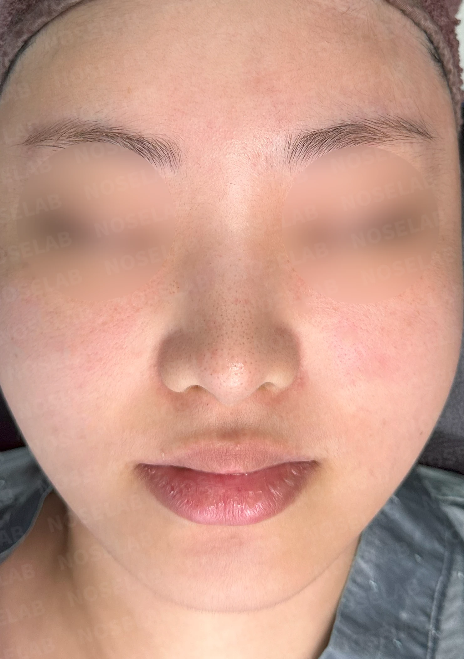 퍼진 코 개선과 콧구멍 비대칭 교정 방법 — 본문 사진 9
