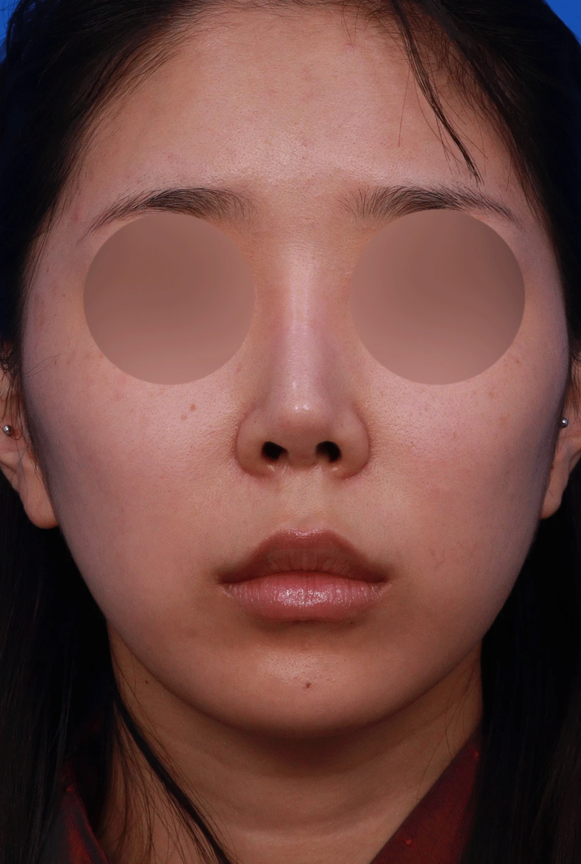 여러 번 수술한 코에 연골이 비치는 이유와 점막·구조 복원 방법 — 디자인 상담 정면 , 좌측 비스듬한 측면 , 측면 사진입니다.