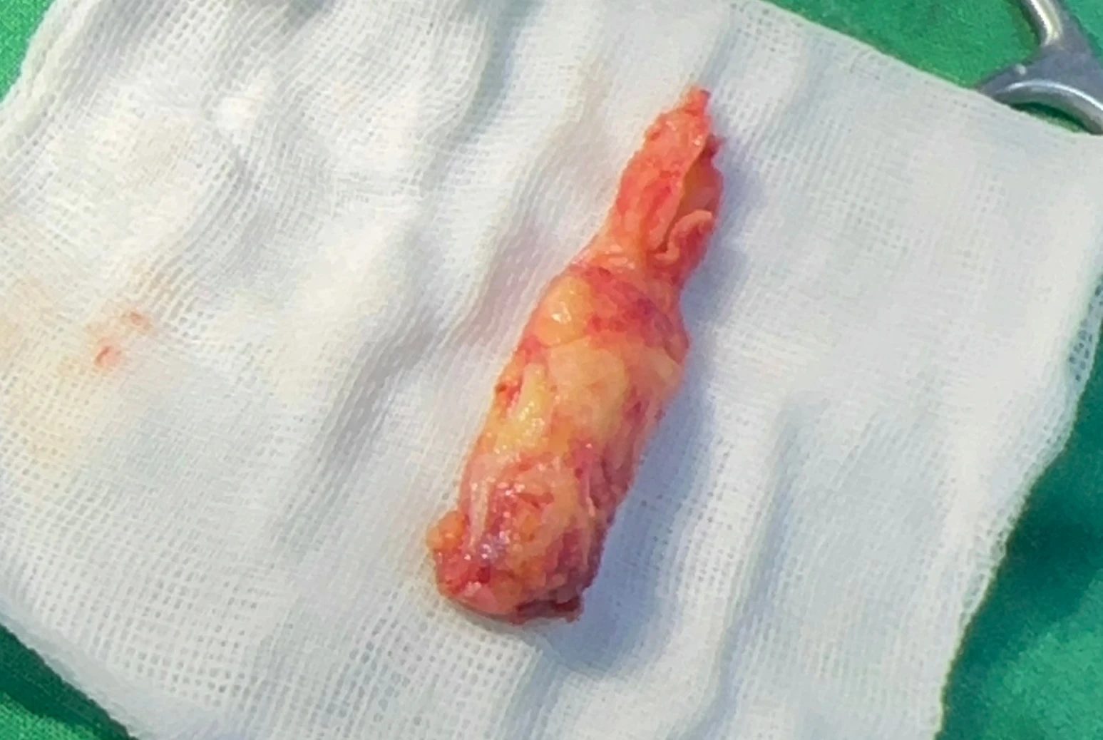 불법 주사 시술 뒤 코가 들리고 짧아지는 이유, 이물질 제거와 재건은 어떻게 하나 — 제거된 이물질 사진입니다.