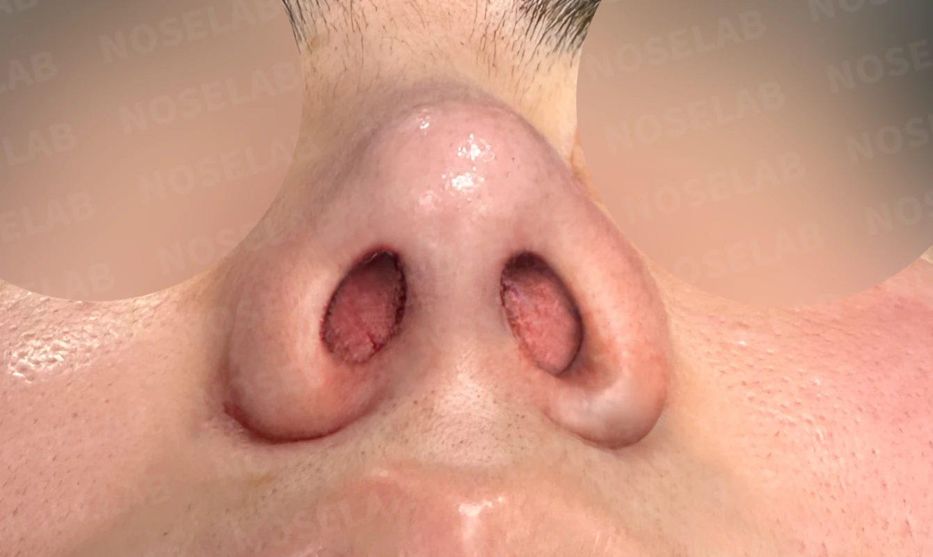 짧고 들려 보이는 작은 코, 왜 무리하게 높이지 않는가 — 수술 전 / 수술 직후 0일 직후 사진은 부기가 있는 상태로 최종 결과와 다를 수 있습니다.
