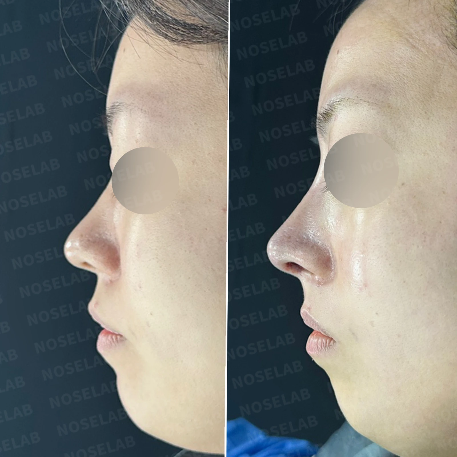 재수술 뒤에도 복코와 퍼진 코끝이 남는 이유, 자가 늑연골 재건은 어떻게 하나 — 본문 사진 20