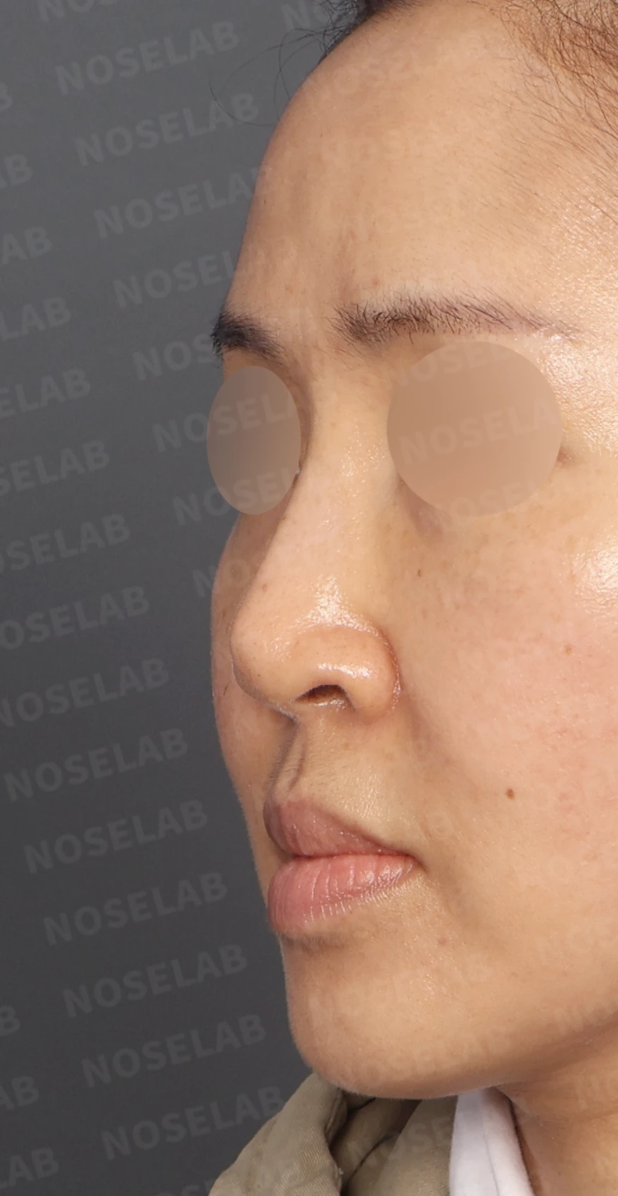 보형물 비침과 용코, 자가늑연골로 안전하게 교정한 코재수술 — 디자인 상담 정면, 좌측 측면, 비스듬한 측면 사진입니다.