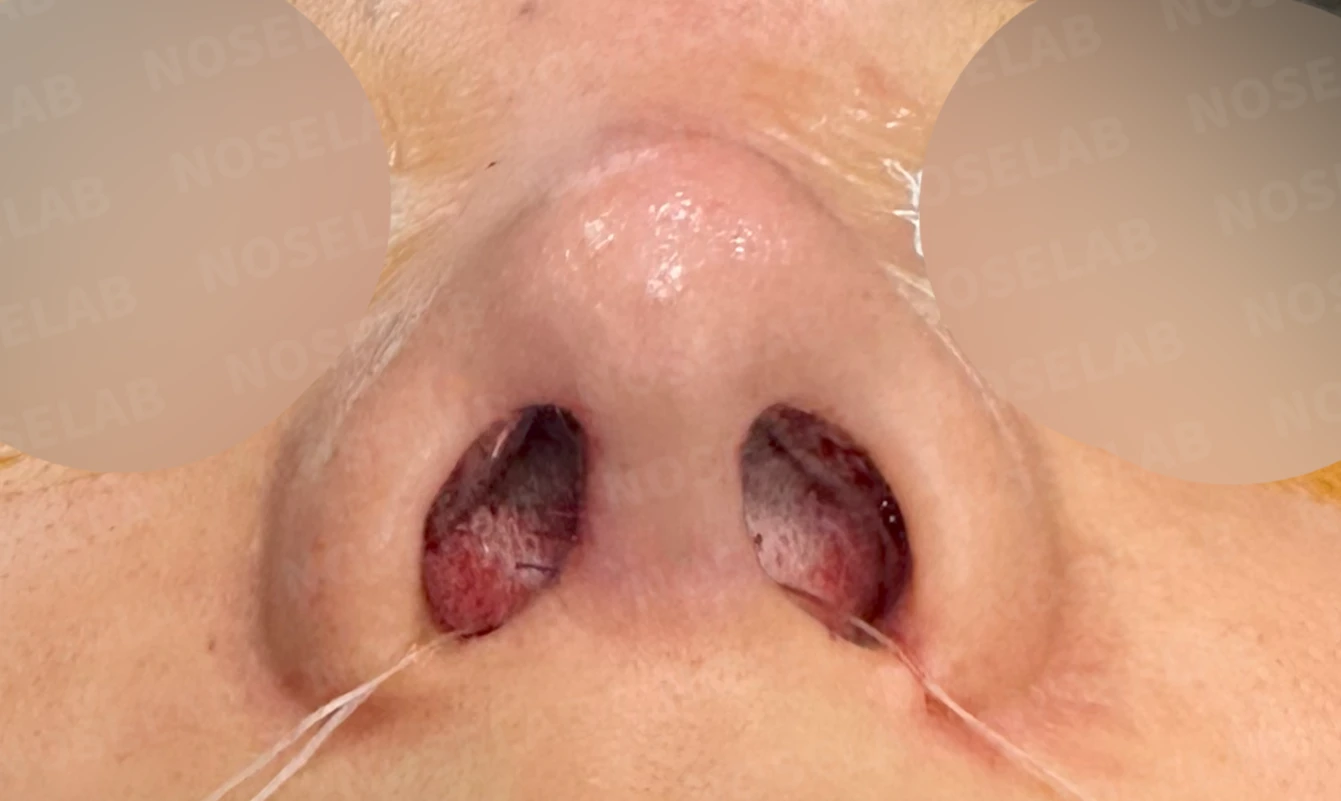 코가 휘어 보이고 비주가 한쪽으로 기우는 이유, 교정은 어떻게 하나 — 수술 전 / 수술 직후 0일 직후 사진은 부기가 있는 상태로 최종 결과와 다를 수 있습니다.