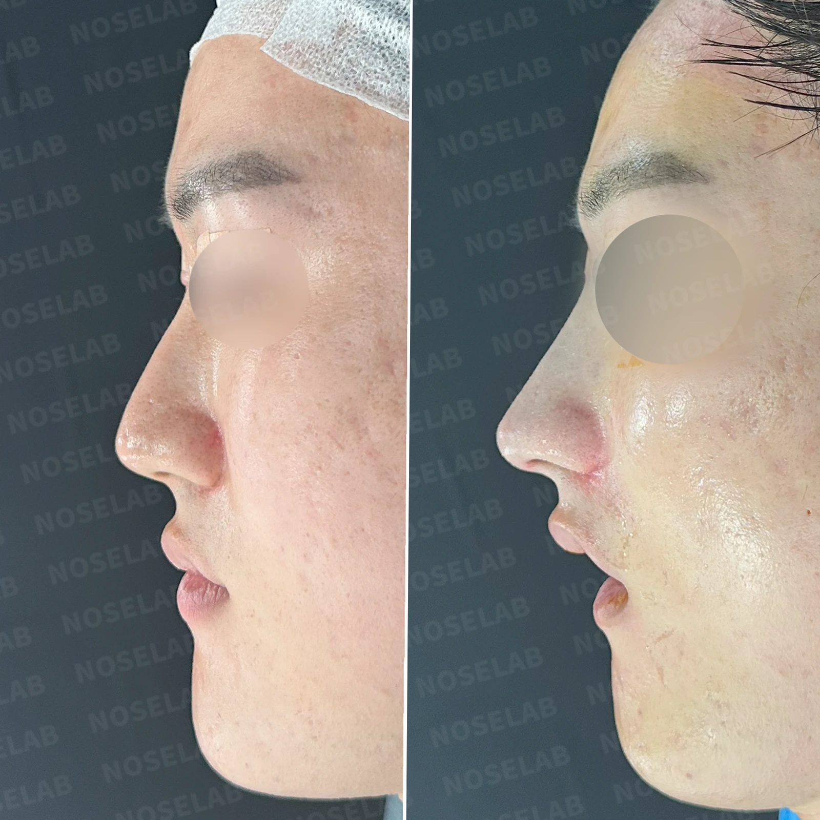 보형물 없이 코끝과 경계 부분만 교정하는 방법 — 본문 사진 20