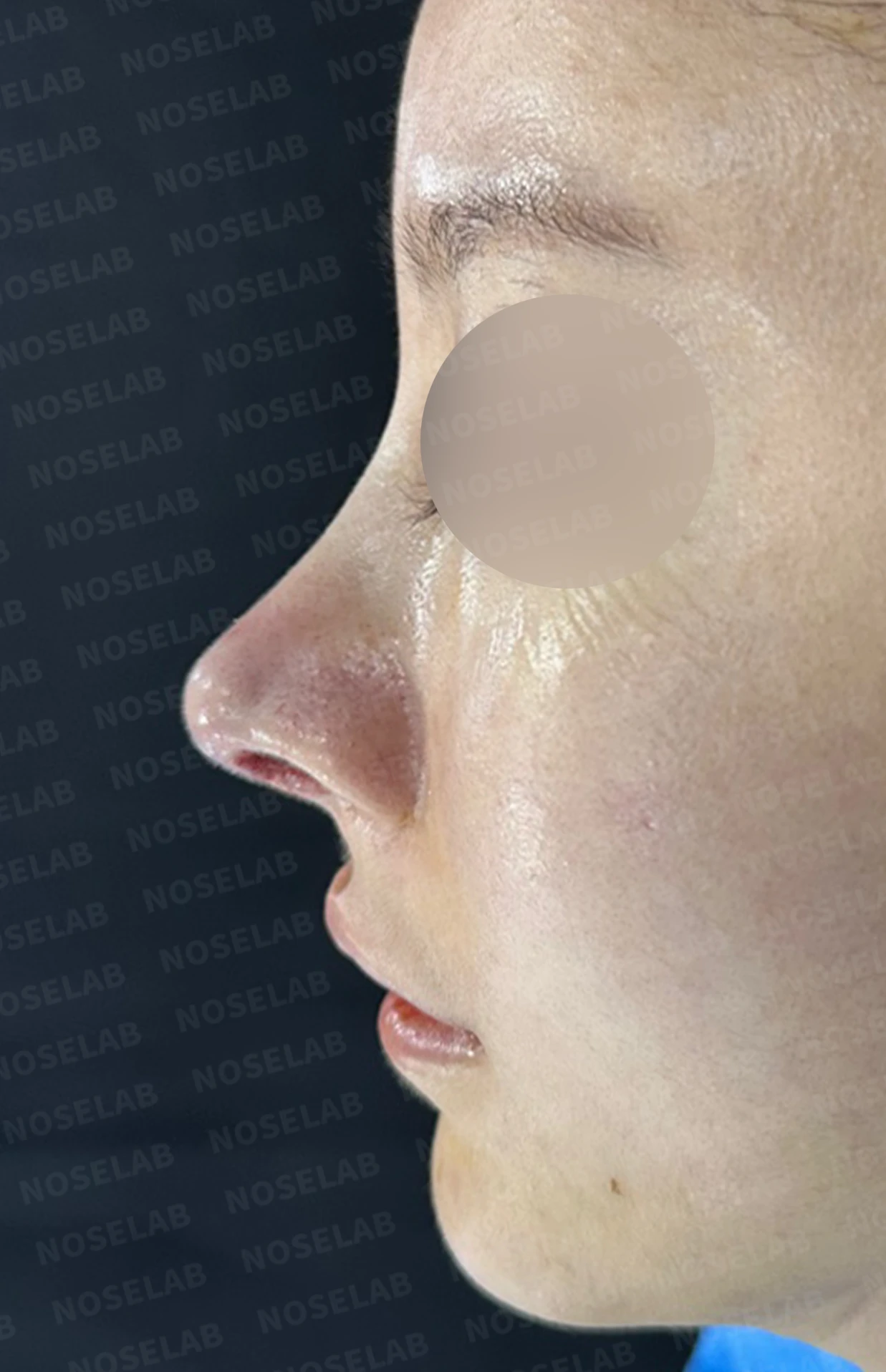 실리콘 보형물이 코끝 피부를 뚫고 나오려 할 때, 왜 생기고 어떻게 재건하나 — 수술 전 / 수술 직후 0일 직후 사진은 부기가 있는 상태로 최종 결과와 다를 수 있습니다.