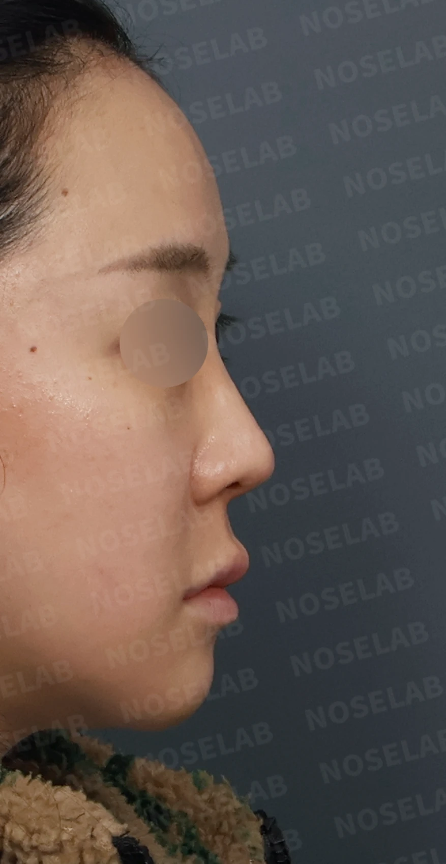 들린코 교정과 코막힘 개선, 자가늑연골로 코재수술 후기 — 디자인 상담 우측 측면, 비스듬한 측면, 비공 사진입니다.