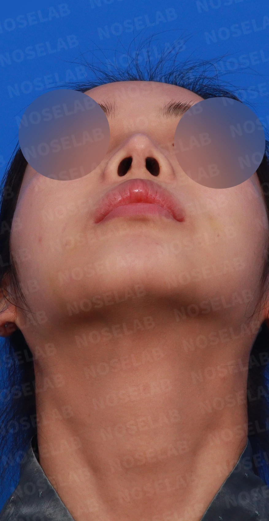 적절하지 않은 L자 실리콘 개선 - 안전한 구조로 재건 후기 — 디자인 상담 우측 비스듬한 측면, 측면, 비공 사진
