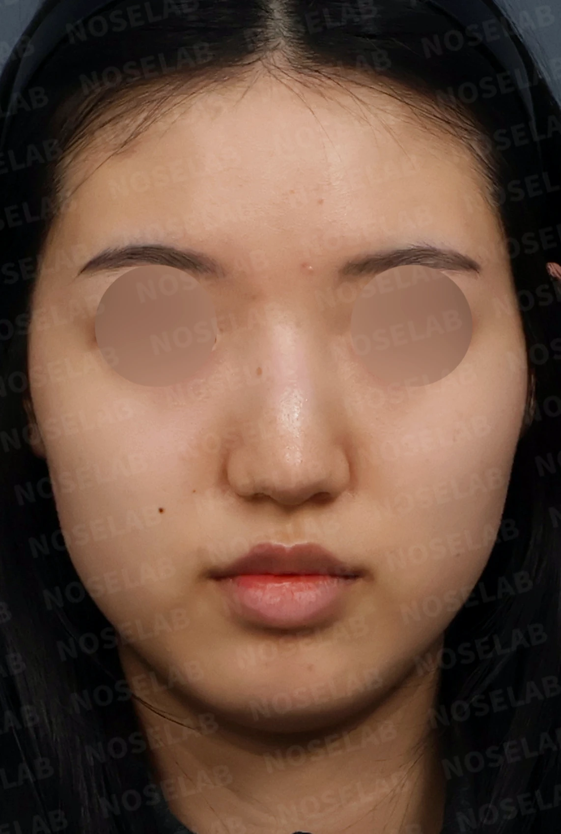 매부리코와 긴코 교정, 자가늑연골로 오똑한 코끝과 코막힘까지 해결 — 디자인 상담 정면, 좌측 측면, 비스듬한 측면 사진입니다.