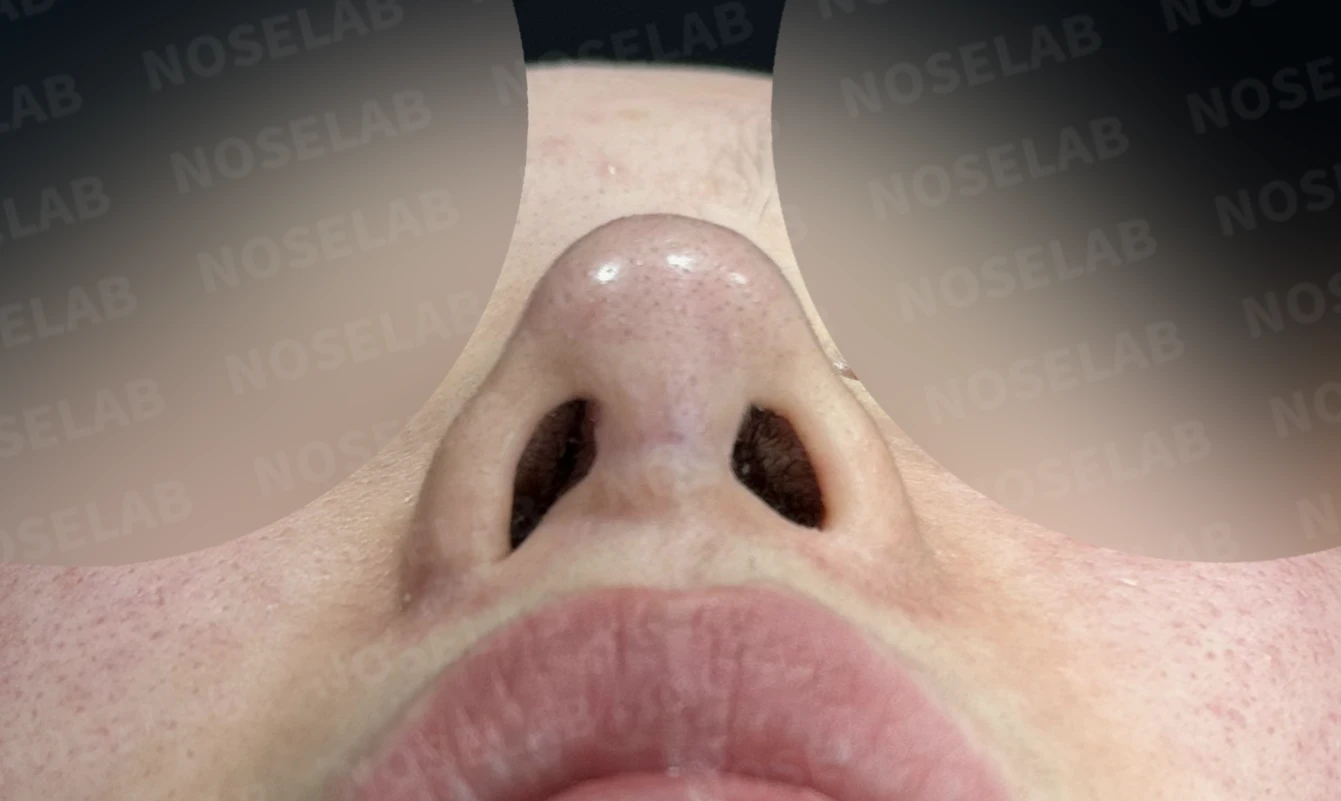 이물질 제거와 자가늑연골 비중격 재건, 들린 코 교정한 코재수술 — 전(좌) 직후(후)