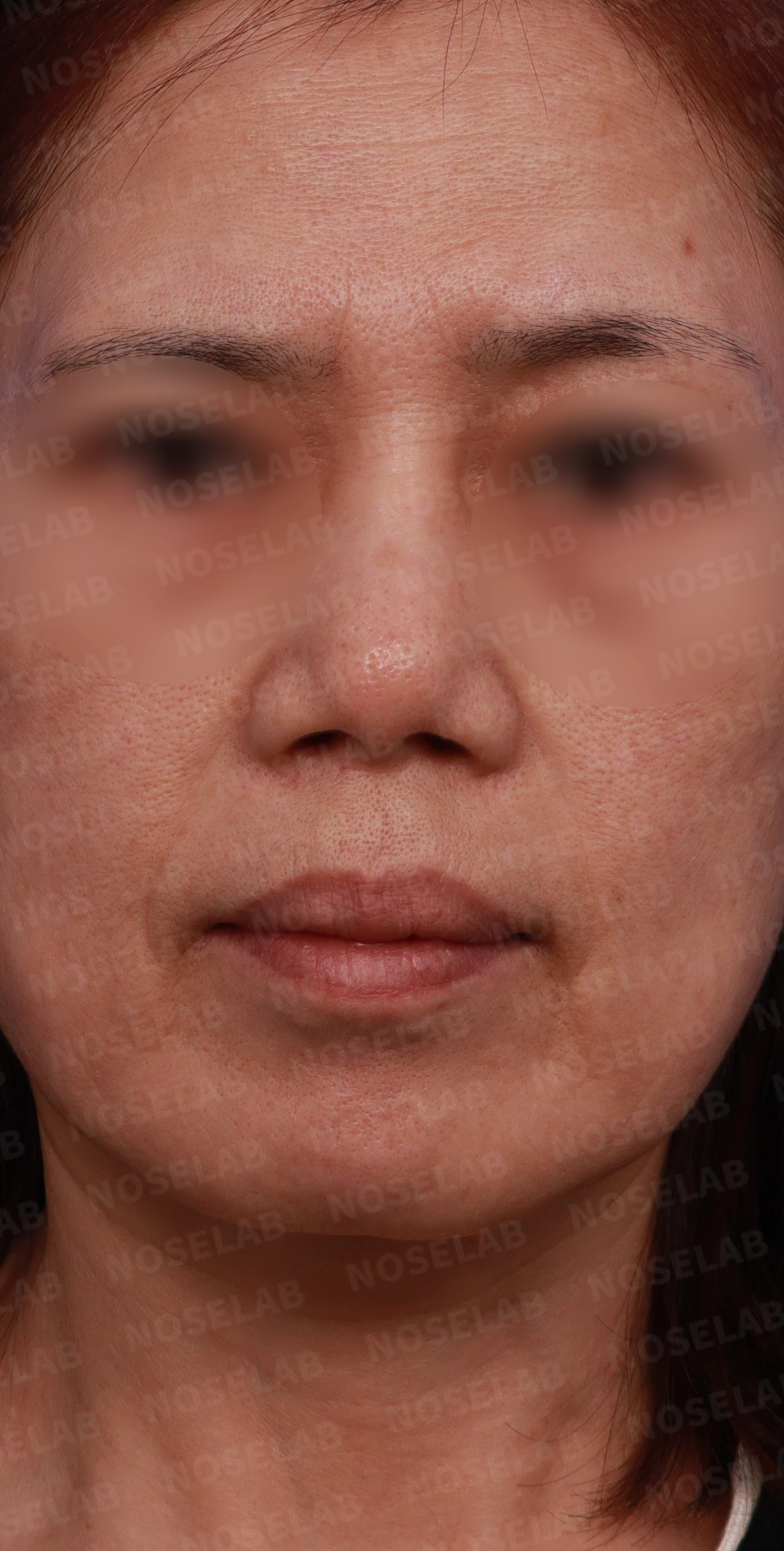 뭉툭하고 퍼진 코의 구조 및 교정 방법 — 디자인 상담 정면 사진입니다.