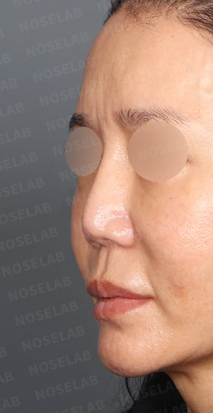 실리콘 재수술, 자가늑연골로 안전하게 코 라인 교정한 사례 — 디자인 상담 정면, 좌측 측면, 비스듬한 측면 사진입니다.