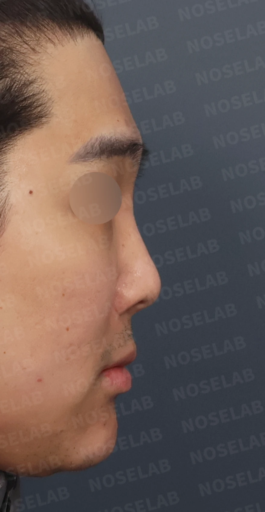휜코 교정과 비공 비대칭, 자가늑연골로 바로잡은 코재수술 — 디자인 상담 우측 측면, 비스듬한 측면, 비공 사진입니다.