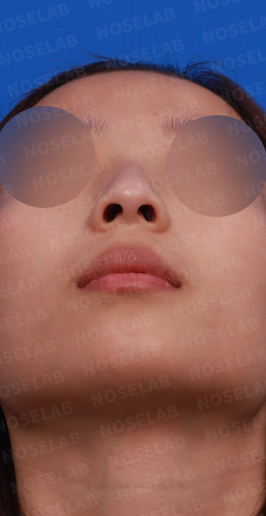 외상 뒤 심해진 매부리와 휜 코, 변화를 최소로 두는 교정 방법 — 디자인 상담 우측 측면, 비스듬한 측면, 비공 사진