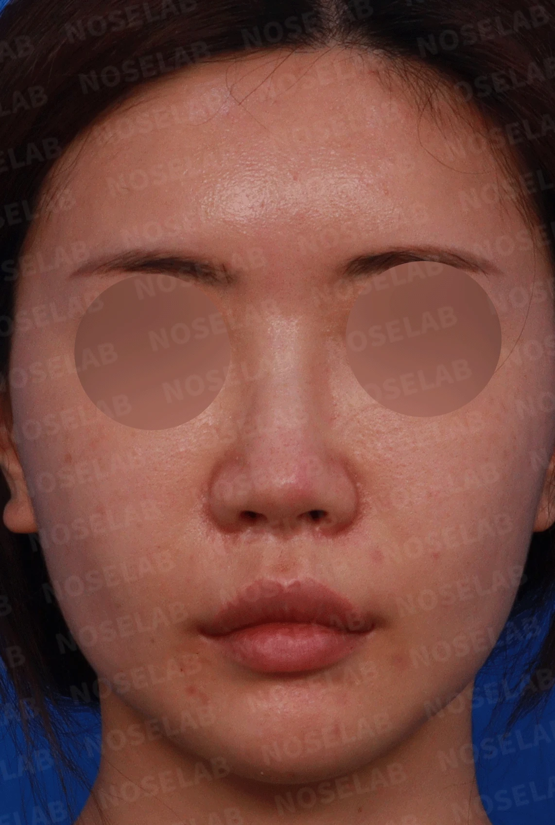 이전 수술로도 달라지지 않는 뭉툭한 코끝, 원인과 재건 방법 — 디자인 상담 정면 , 좌측 비스듬한 측면 , 측면 사진입니다.