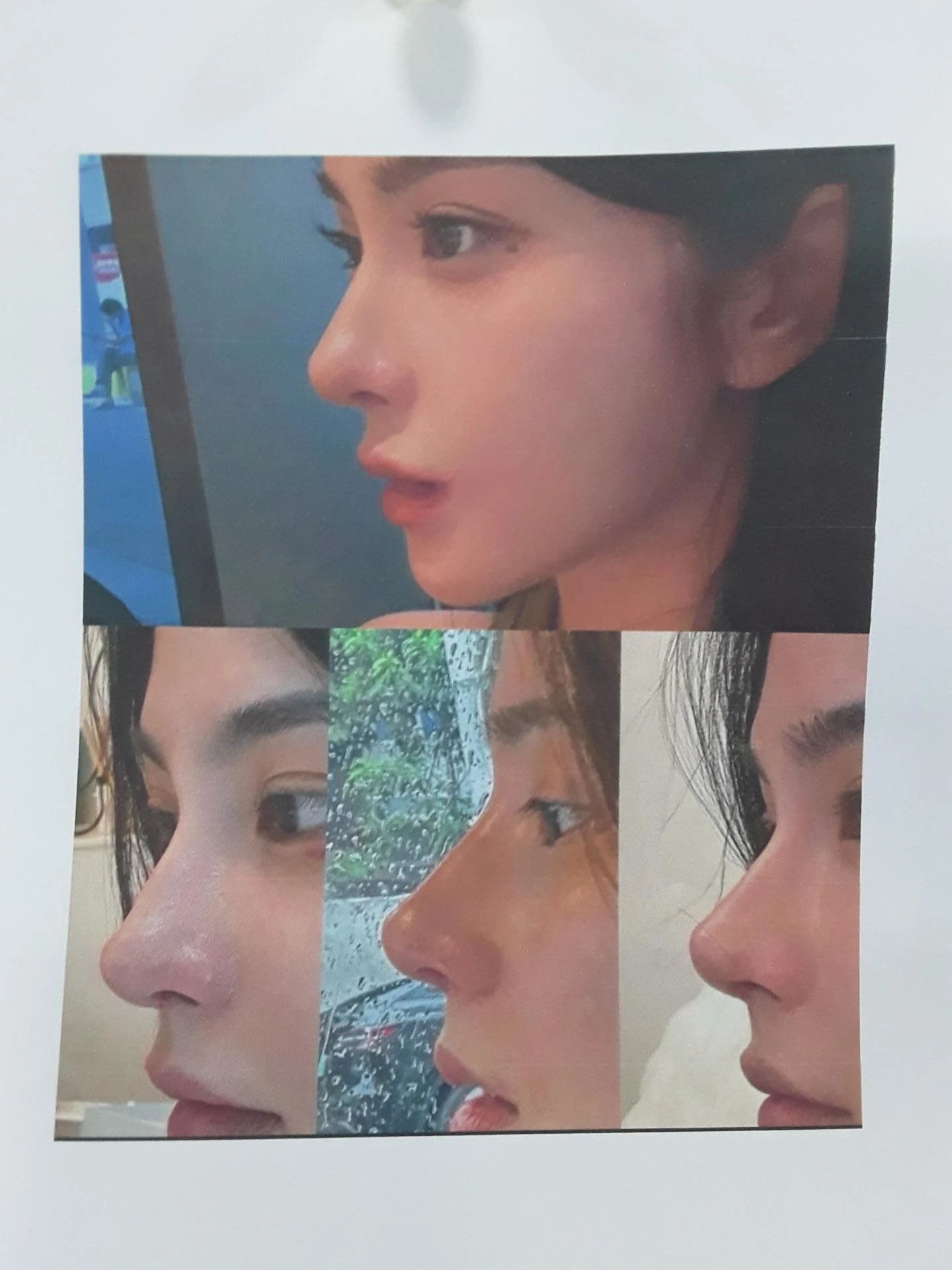 실리콘 보형물이 코끝 피부를 뚫고 나오려 할 때, 왜 생기고 어떻게 재건하나 — 본문 사진 10