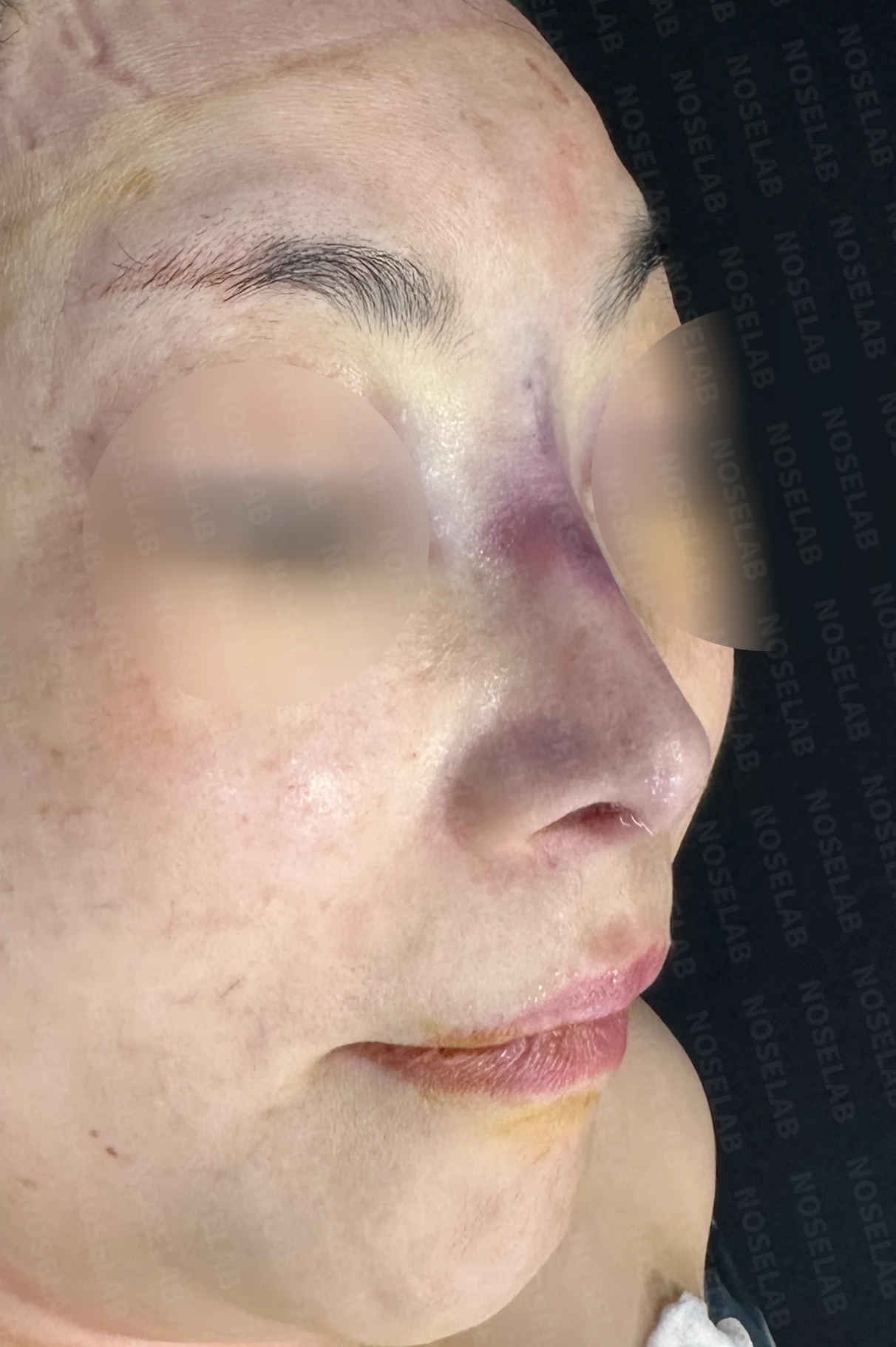 작고 들린 코에서 필러 제거와 교정을 계획하는 방법 — 수술 직후 0일 정면, 측면, 비스듬한 측면 사진 직후 사진은 부기가 있는 상태로 최종 결과와 다를 수 있습니다.