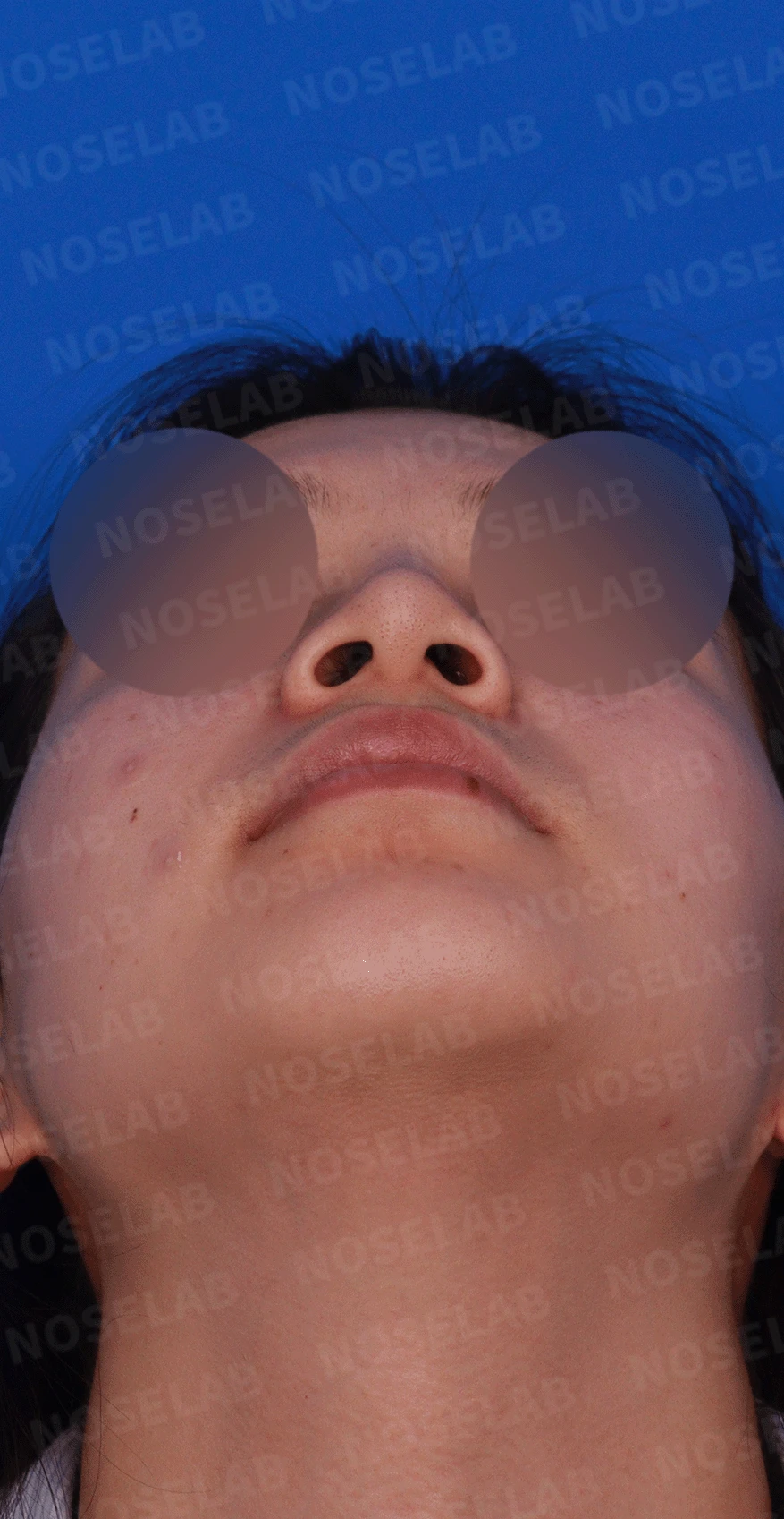 복코가 잘 교정되지 않는 이유와 이물질 제거 후 재건 방법 — 디자인 상담 우측 측면 , 비스듬한 측면 , 비공 사진