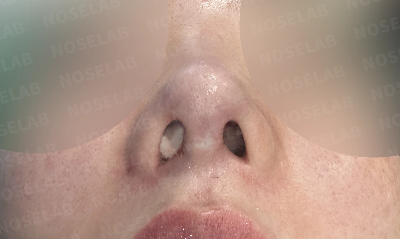 이물질 제거와 자가늑연골 비중격 재건, 들린 코 교정한 코재수술 — 직후 비공 사진입니다.