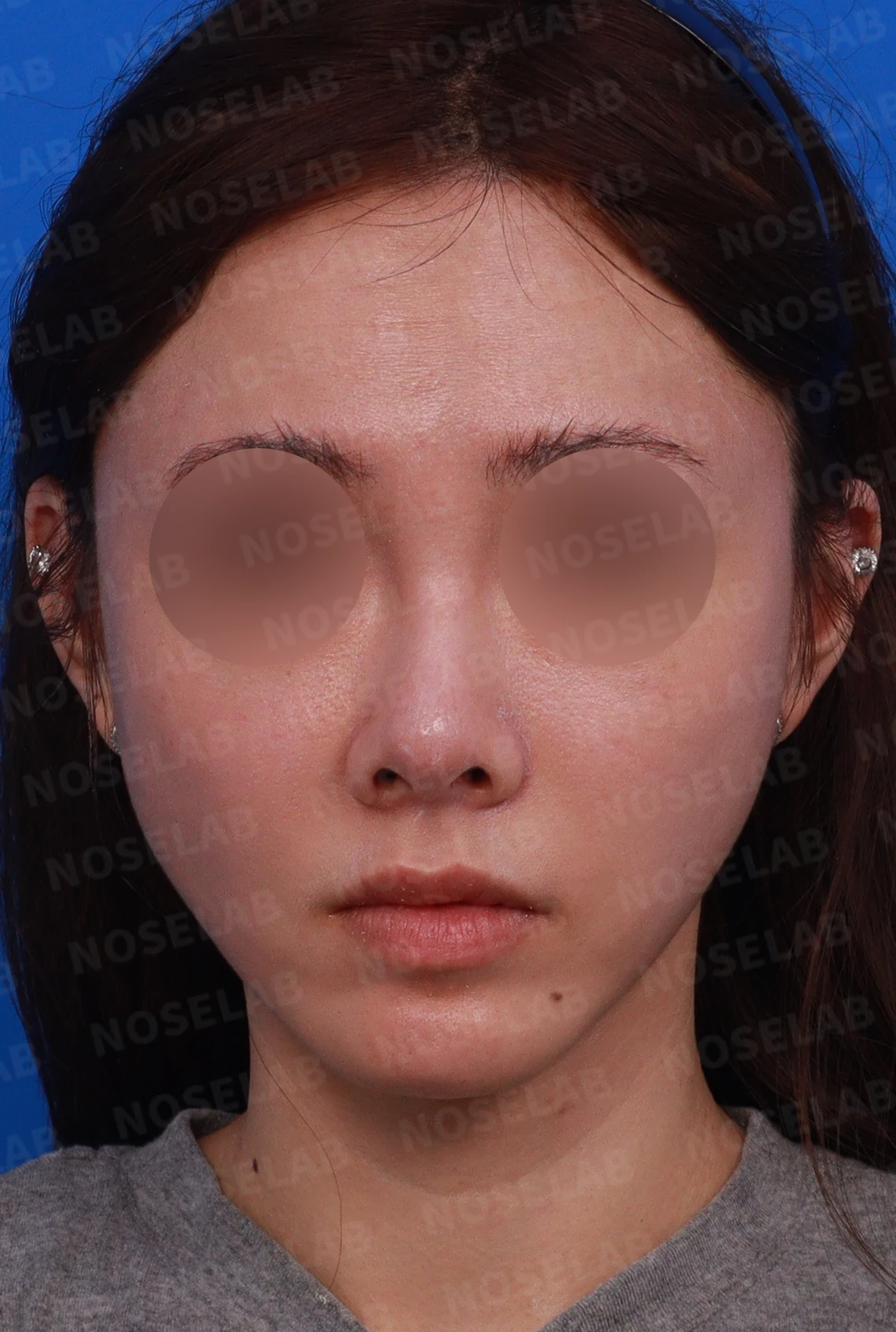 필러와 실 시술을 반복한 코에 미간이 퍼지고 코끝이 들리는 이유 — 디자인 상담 정면 , 좌측 , 비스듬한 측면 , 측면 사진입니다.