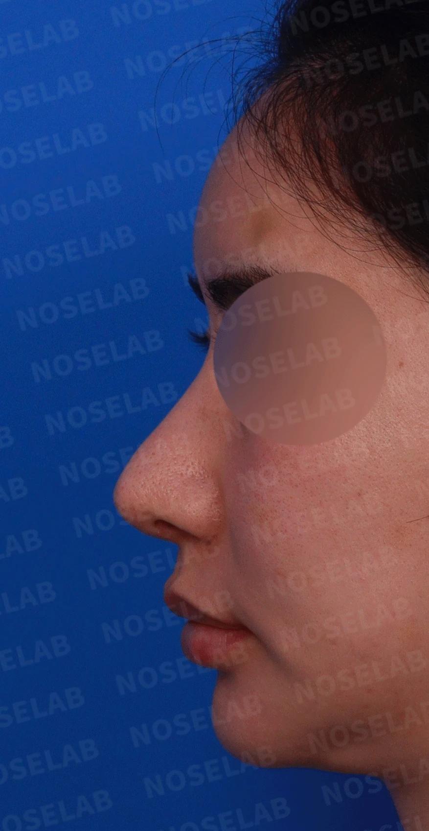 코가 과하게 높아져 부자연스러워 보이고 휘는 이유, 재건은 어떻게 하나 — 디자인 상담 정면 , 좌측 비스듬한 측면 , 측면 사진입니다.