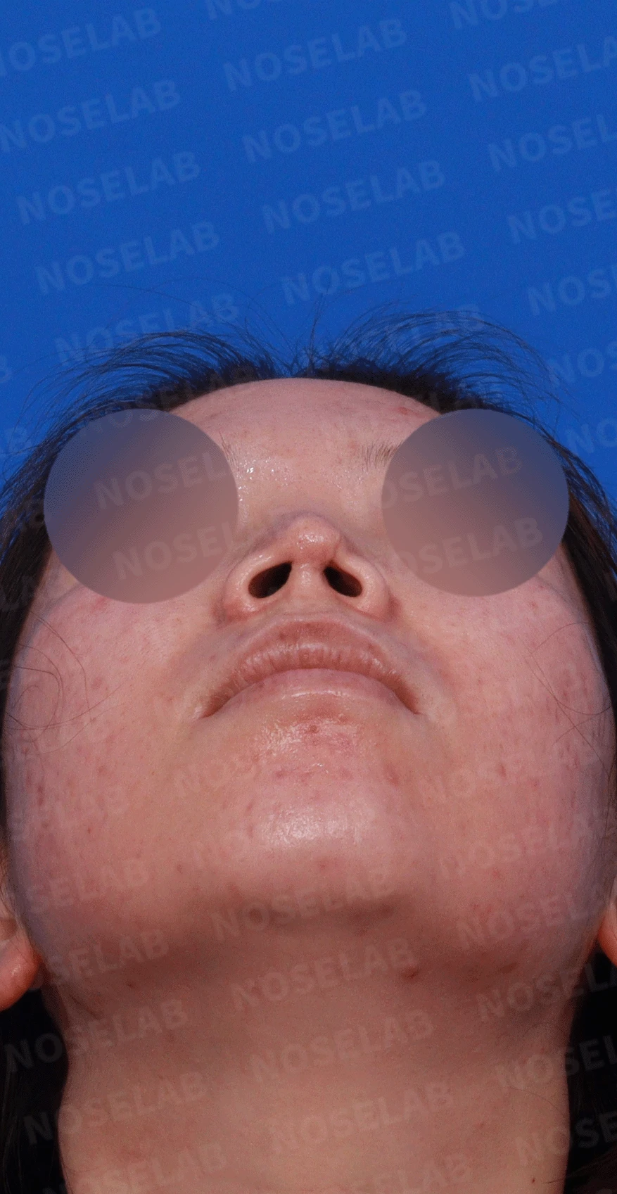 콧구멍을 막는 종괴가 생기는 이유, 제거와 재건은 어떻게 하나 — 디자인 상담 우측 비스듬한 측면 , 측면 , 비공 사진입니다.