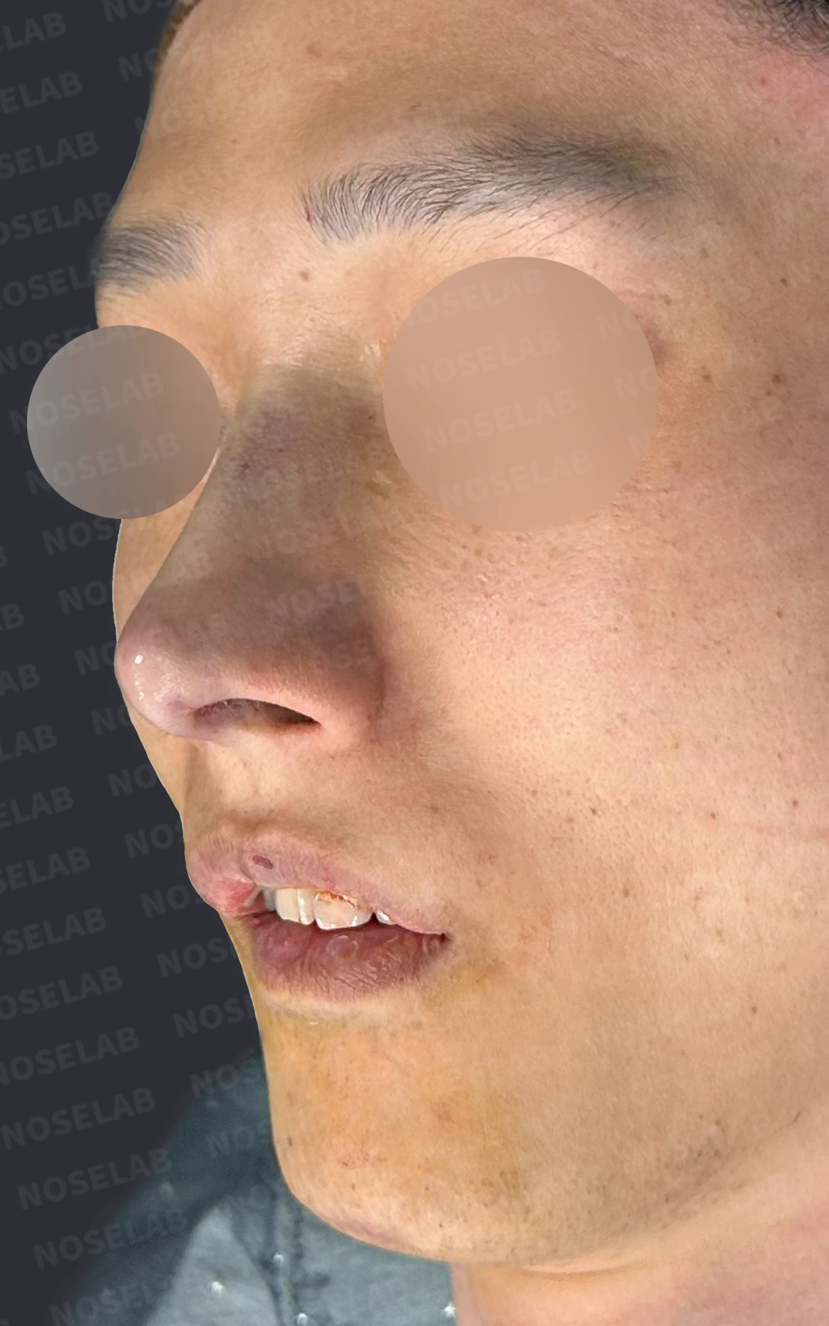 안면 비대칭이 있는 코에 맞춤형 보형물을 쓰는 이유와 매부리 교정 방법 — 본문 사진 13