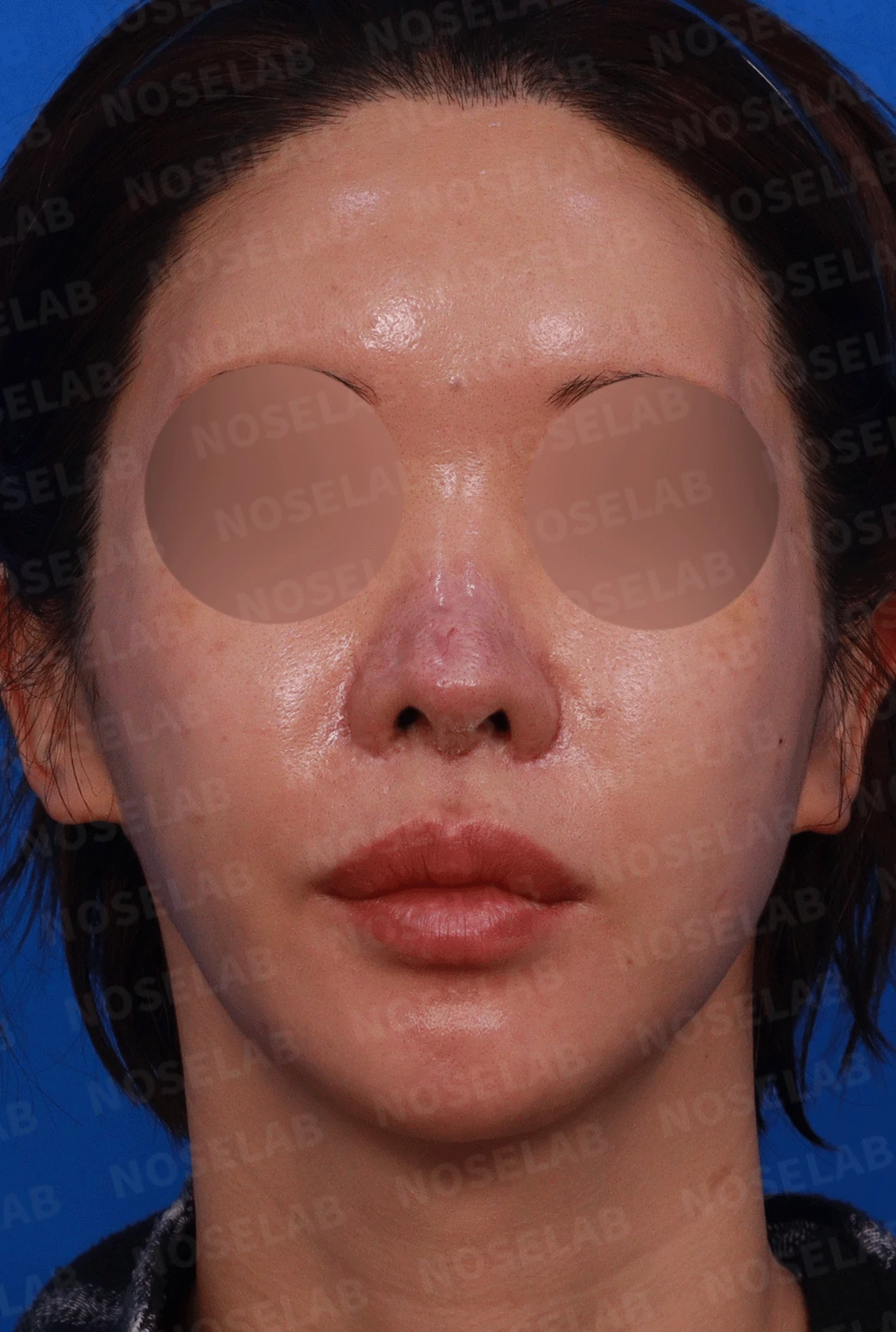 코 수술 뒤 콧등 피부가 괴사하면 어떤 변화가 남고, 재건은 어떻게 하나 — 디자인 상담 정면 , 비스듬한 측면 사진, 우측 측면