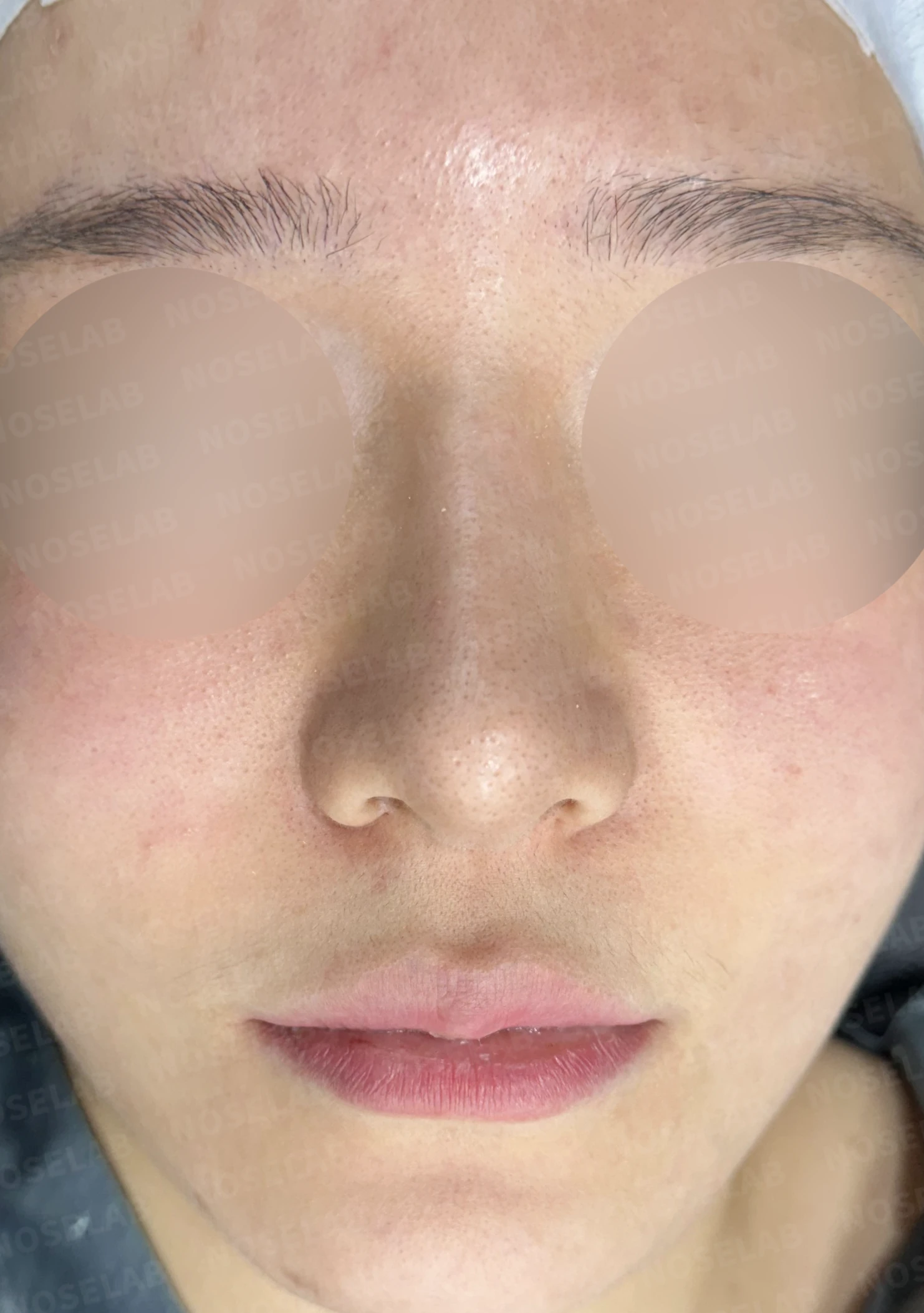 뭉툭하고 처진 긴코, 비개방 코재수술로 여성스러운 직반라인 완성 — 전(좌) 직후(후)