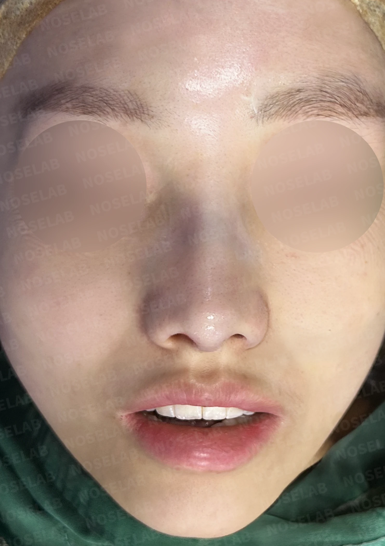 무보형물 코성형, 휘어진 콧대와 처진 코끝을 자연스럽게 교정 — 직후 정면, 비스듬한 측면, 측면 사진입니다.
