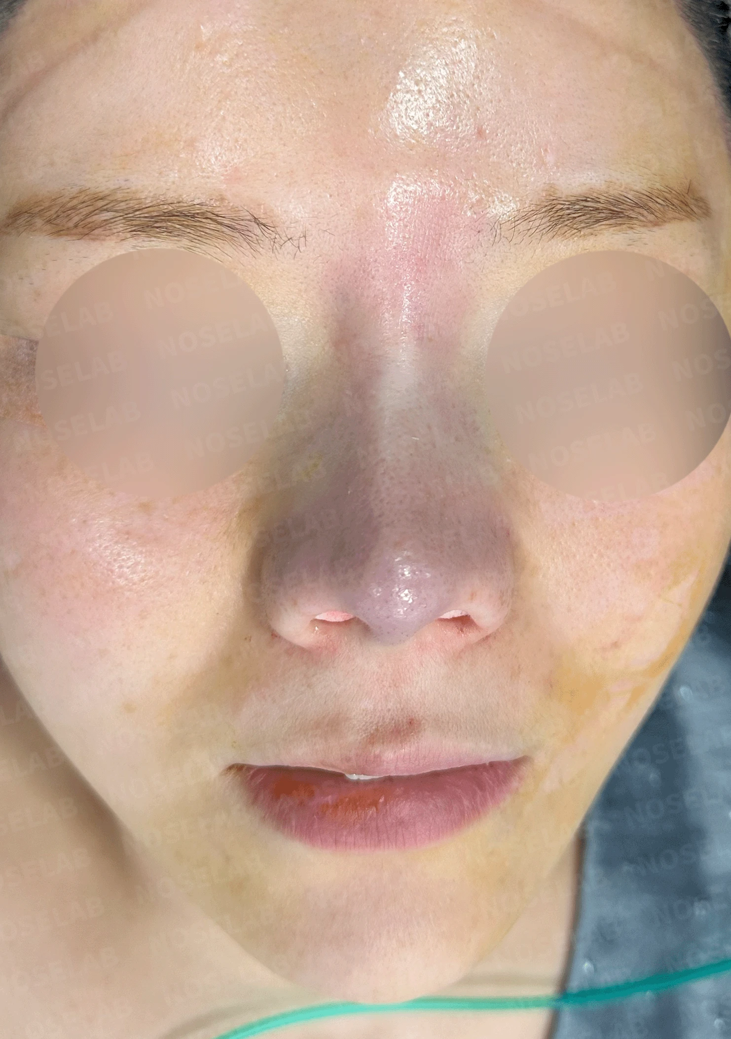 늑연골 석회화를 미리 확인해야 하는 이유와 휜코·짧은코 교정 방법 — 본문 사진 8