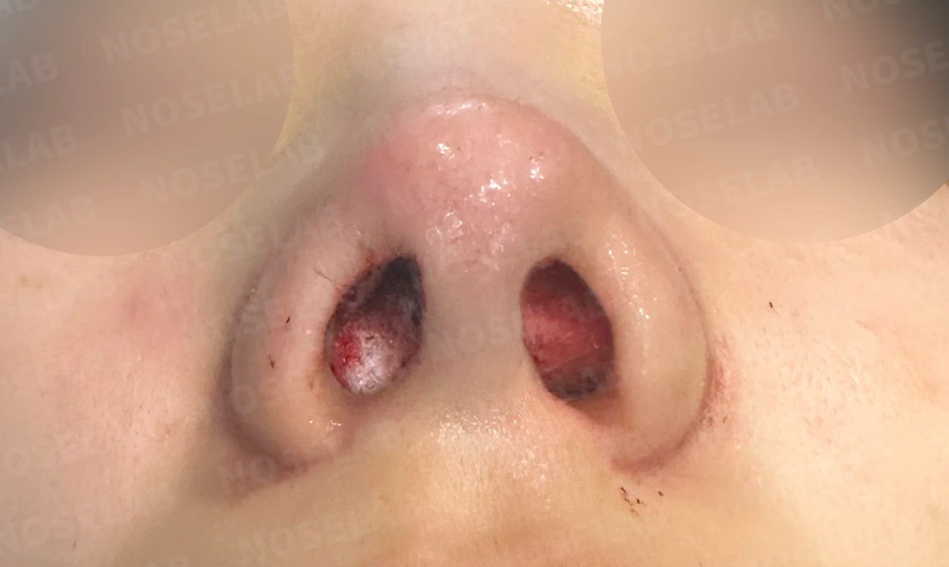 매부리를 정리한 뒤 콧등이 눌려 보이고 코끝이 뭉툭해지는 이유, 보형물 없이 교정하는 방법 — 수술 직후 0일 비공 사진 직후 사진은 부기가 있는 상태로 최종 결과와 다를 수 있습니다.