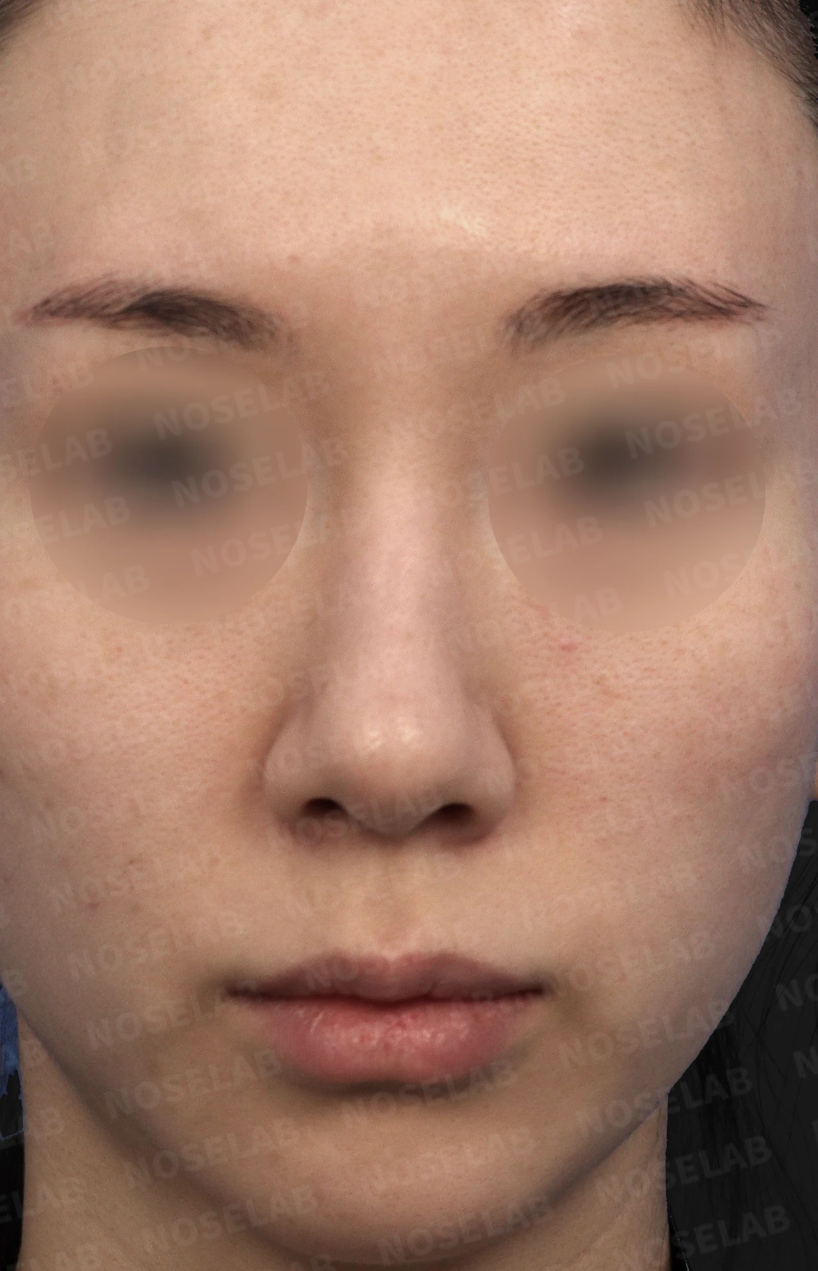 뭉툭한 복코의 구조와 교정 방법 — 본문 사진 1