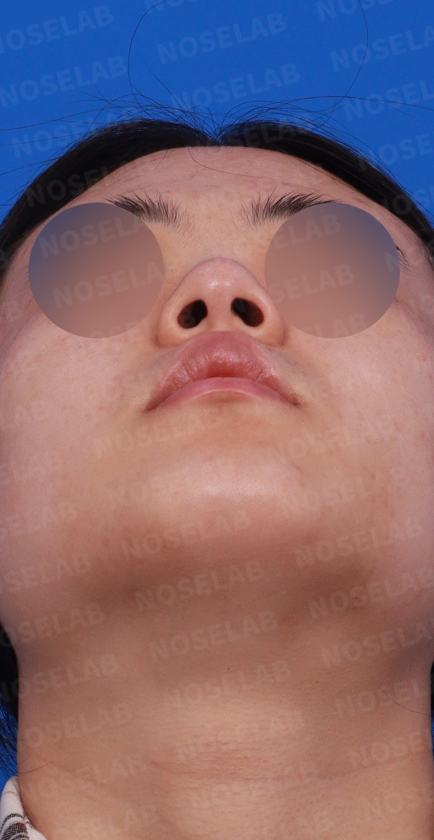 코끝 피부가 두껍고 잘 늘어나지 않는 코에서 높이와 직반 라인을 만드는 방법 — 디자인 상담 우측 비스듬한 측면, 측면, 비공 사진