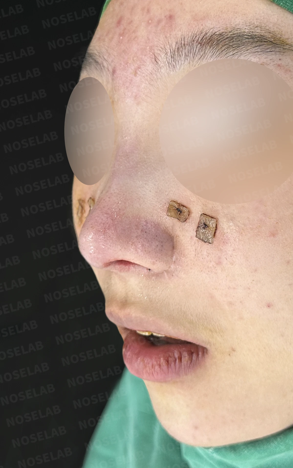 메드포어로 손상된 비중격, 자가늑연골로 완벽하게 재건하다 — 전(좌) 직후(후)