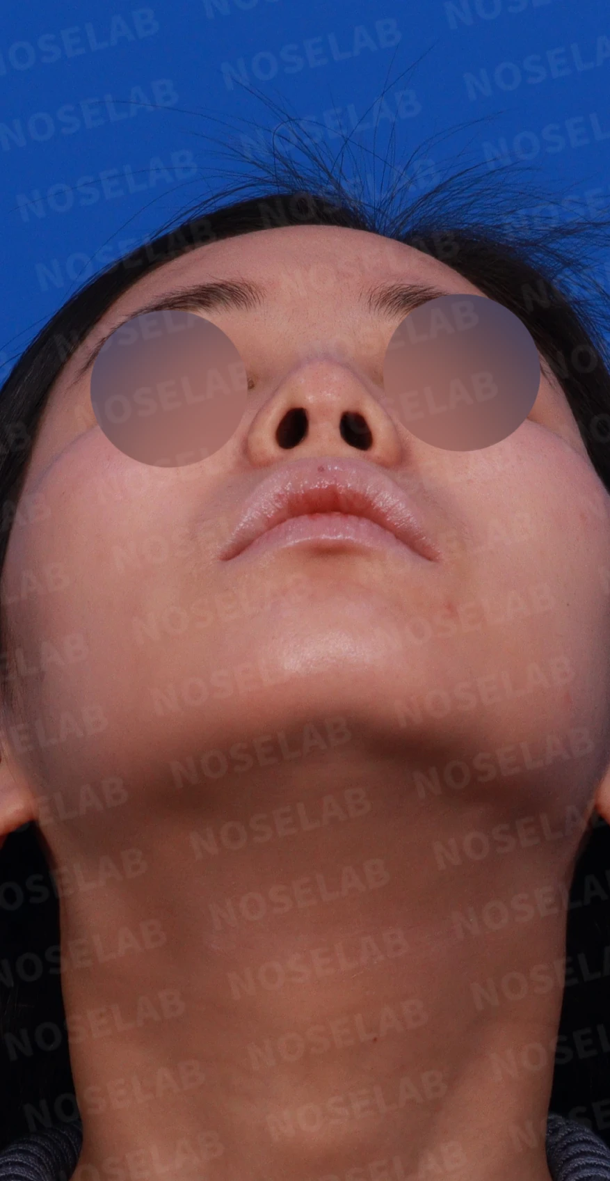 알레르기 체질에서 자가늑연골 무보형물 코성형을 계획할 때 — 디자인 상담 우측 측면, 비스듬한 측면, 비공 사진입니다.
