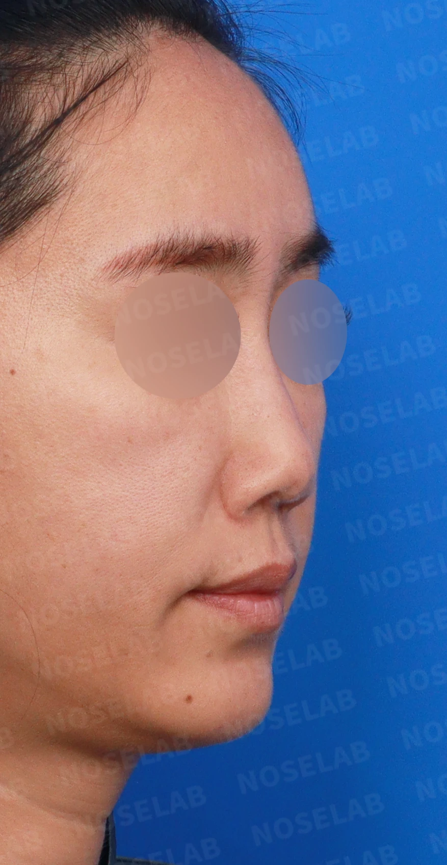 콧대에 주입한 불법 시술 이물질, 제거와 비중격 전체 재건은 어떻게 하나 — 디자인 상담 우측 측면, 비스듬한 측면, 비공 사진입니다.