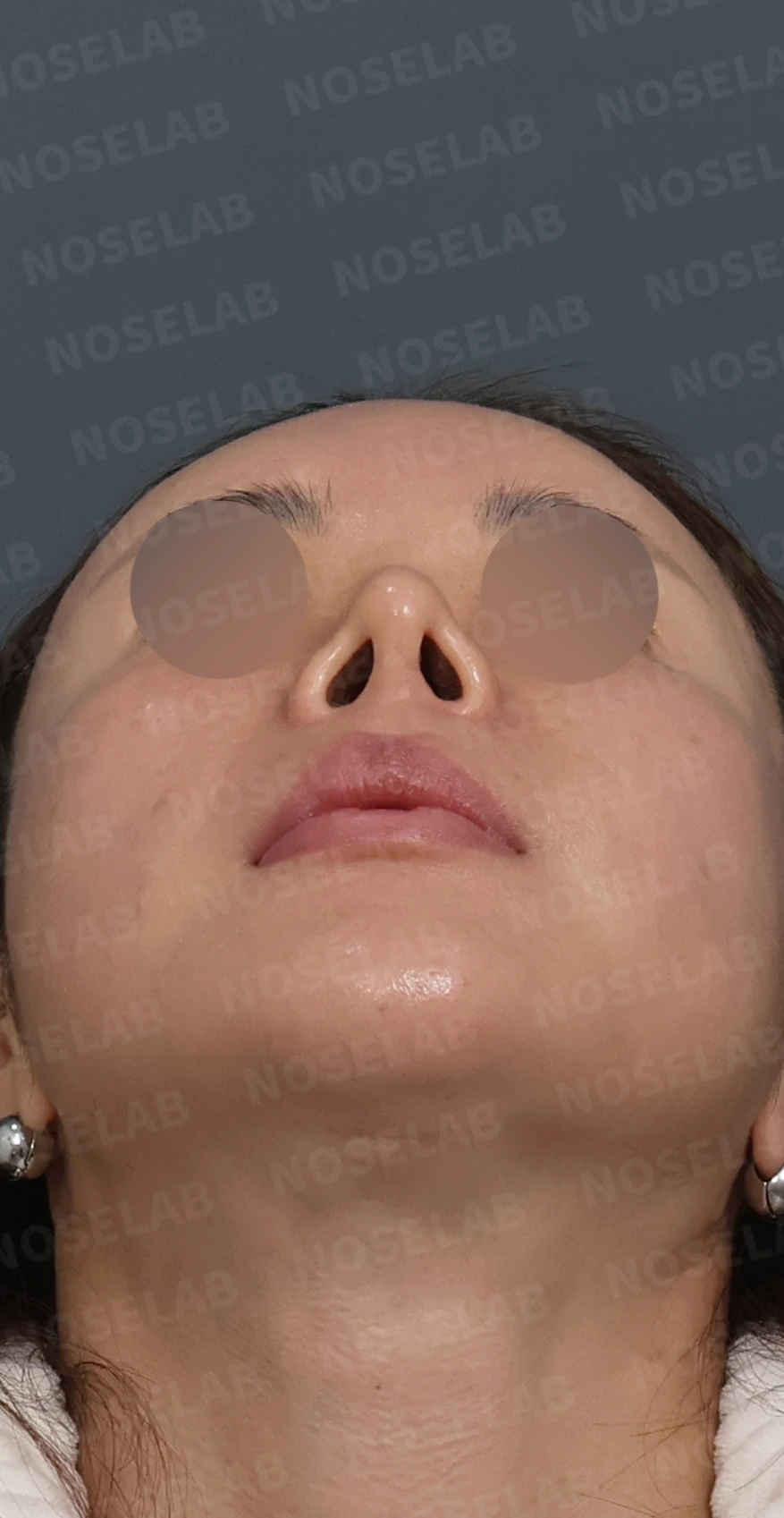 비중격 소실 후 들린 코끝과 찝혀 보이는 콧날개, 자가늑연골로 정밀 재건 — 디자인 상담 우측 측면, 비스듬한 측면, 비공 사진입니다.