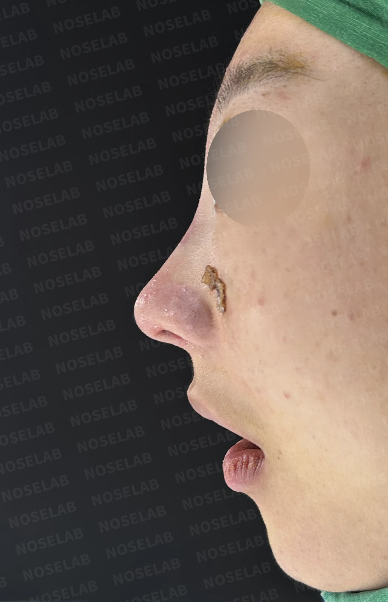메드포어로 손상된 비중격, 자가늑연골로 완벽하게 재건하다 — 전(좌) 직후(후)