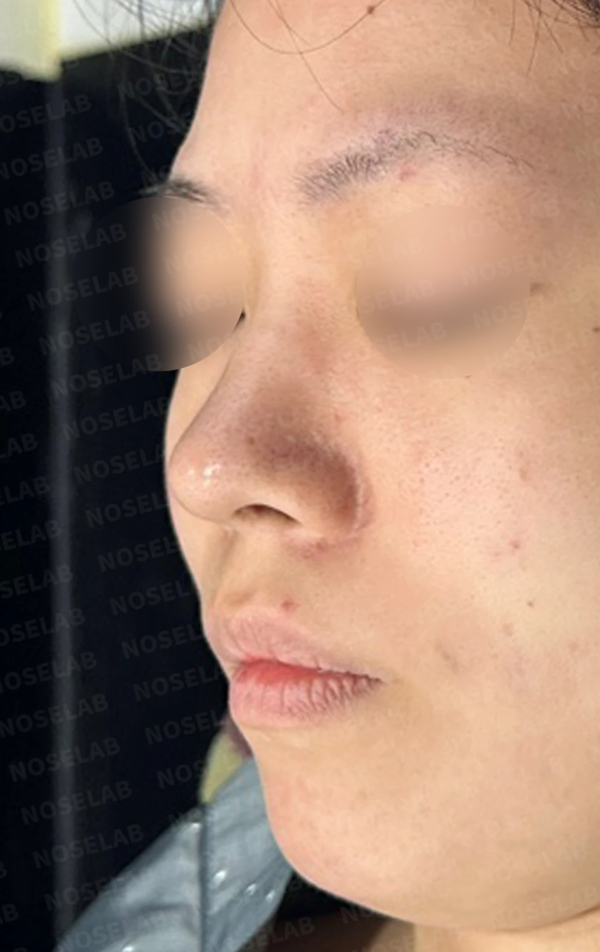 재수술 뒤에도 복코와 퍼진 코끝이 남는 이유, 자가 늑연골 재건은 어떻게 하나 — 수술 전 / 수술 직후 0일 직후 사진은 부기가 있는 상태로 최종 결과와 다를 수 있습니다.