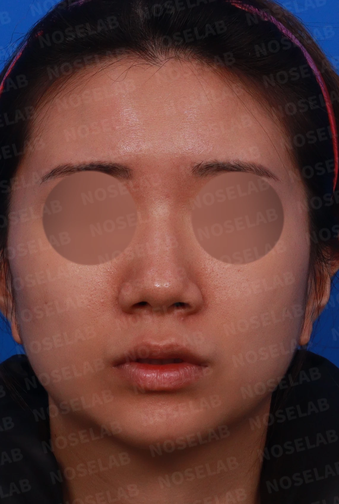 코 필러를 녹이지 않은 채 코가 퍼져 보이는 이유, 얄쌍한 라인을 만드는 방법 — 디자인 상담 정면, 좌측 측면, 비스듬한 측면 사진