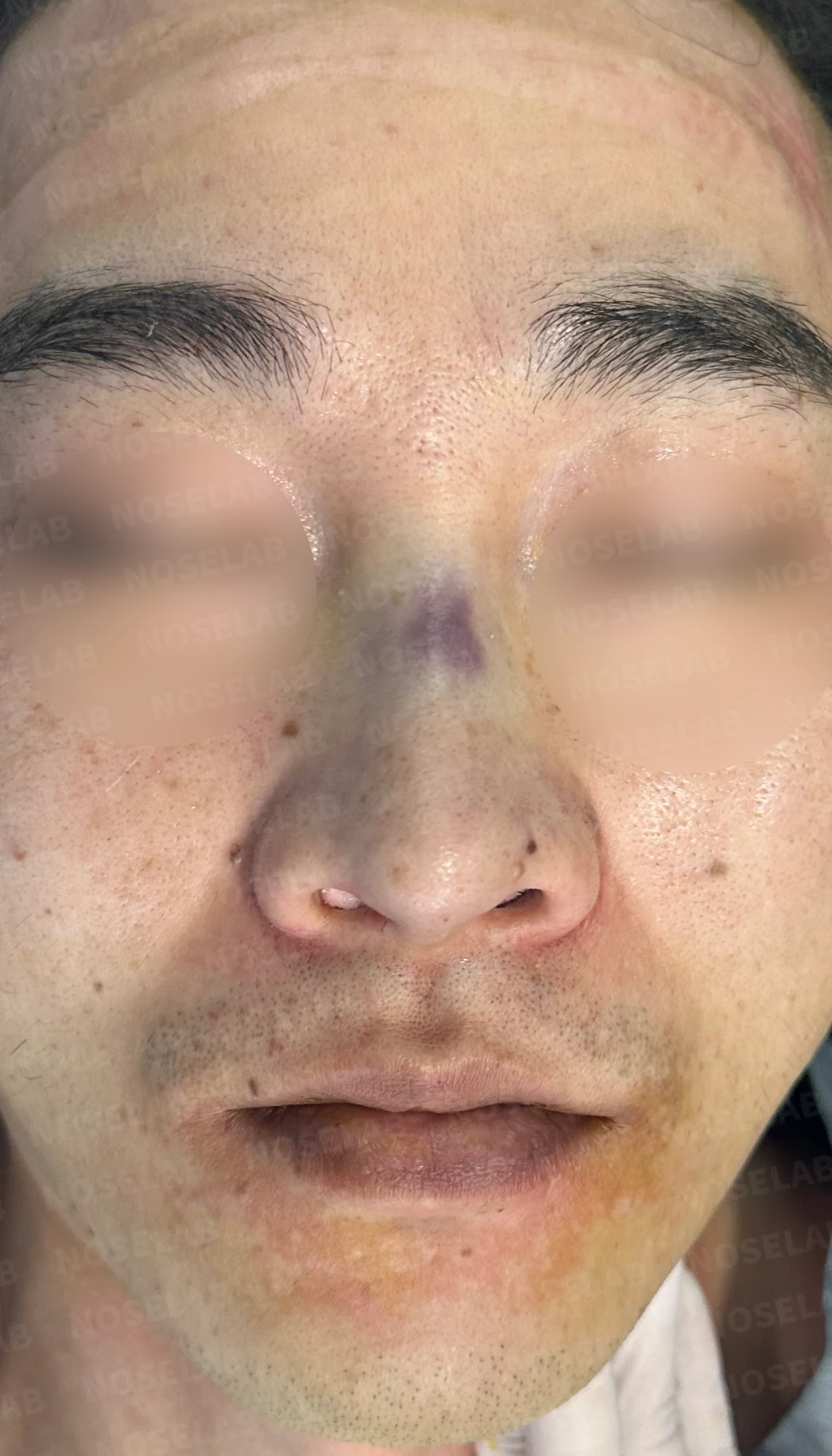 화살코, 휜코 교정 방법 — 수술 전 / 수술 직후 0일 직후 사진은 부기가 있는 상태로 최종 결과와 다를 수 있습니다.