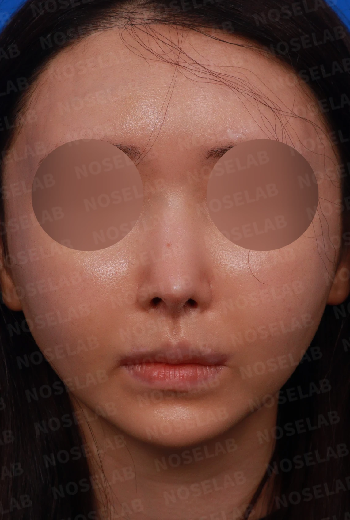 뾰족한 코끝과 연골 비침의 교정 방법 — 디자인 상담 정면, 좌측 측면, 비스듬한 측면 사진입니다.