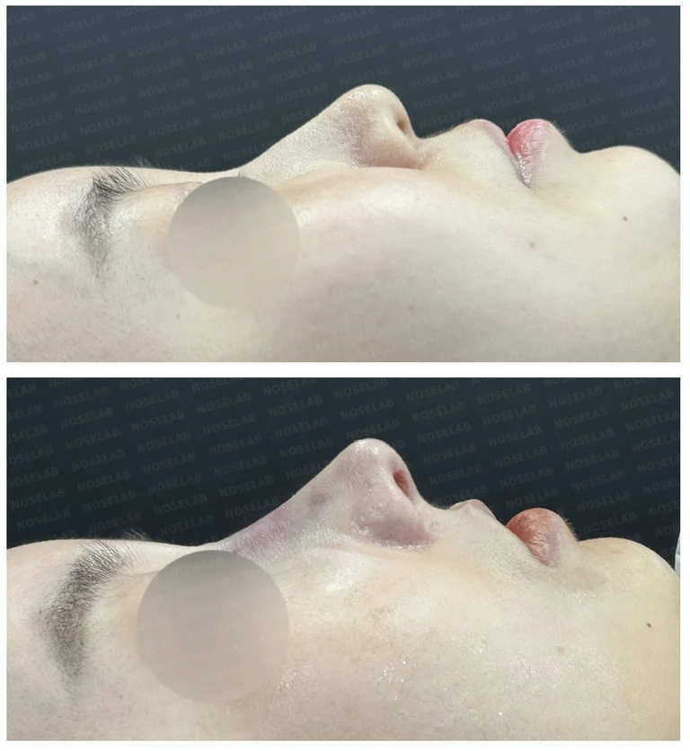 낮은 코의 지지 구조와 자가늑연골 교정 방법 — 전후 비교