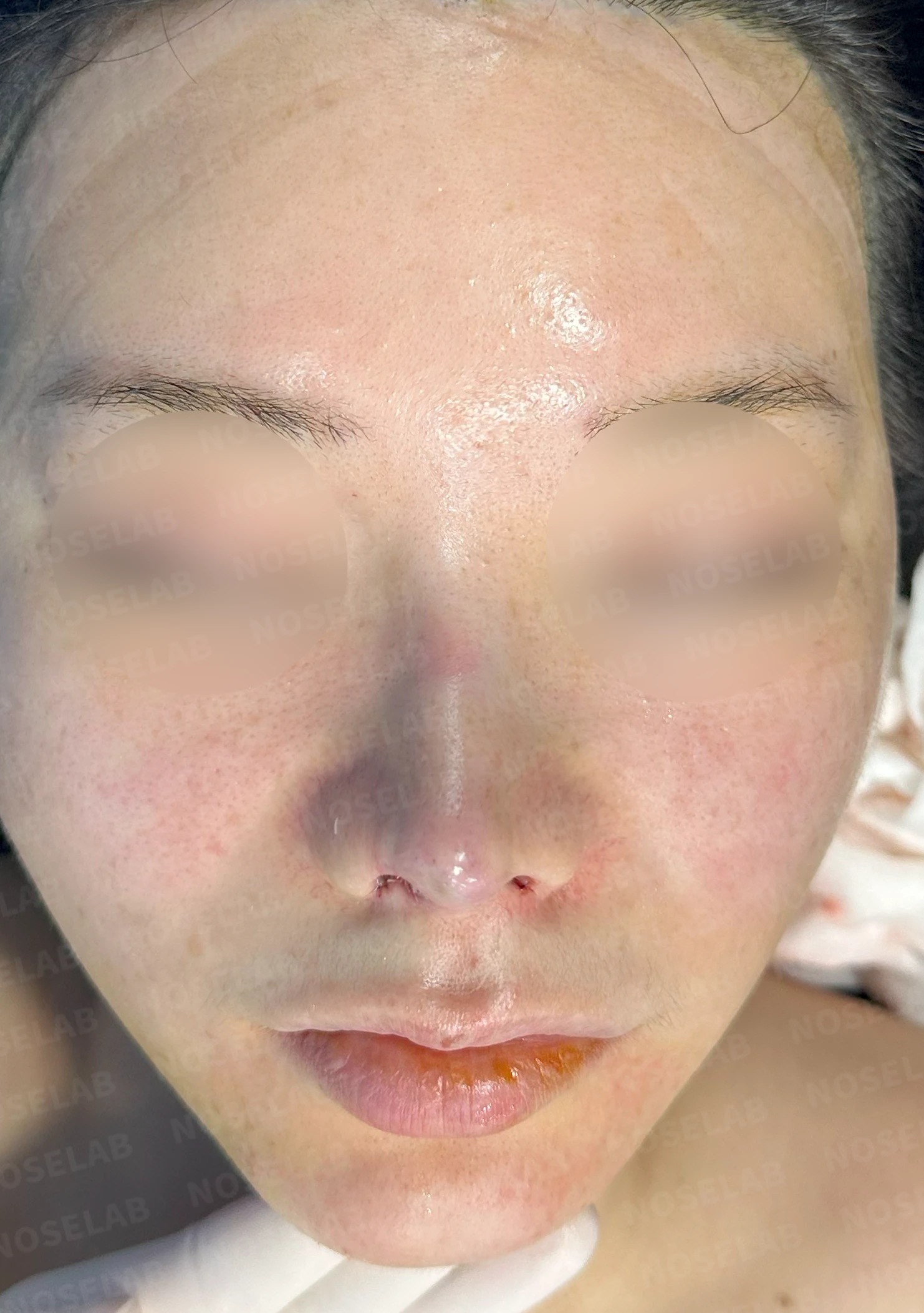 코끝 피부 상태와 괴사 위험을 고려한 재수술 계획 — 수술 전 / 수술 직후 0일 직후 사진은 부기가 있는 상태로 최종 결과와 다를 수 있습니다.