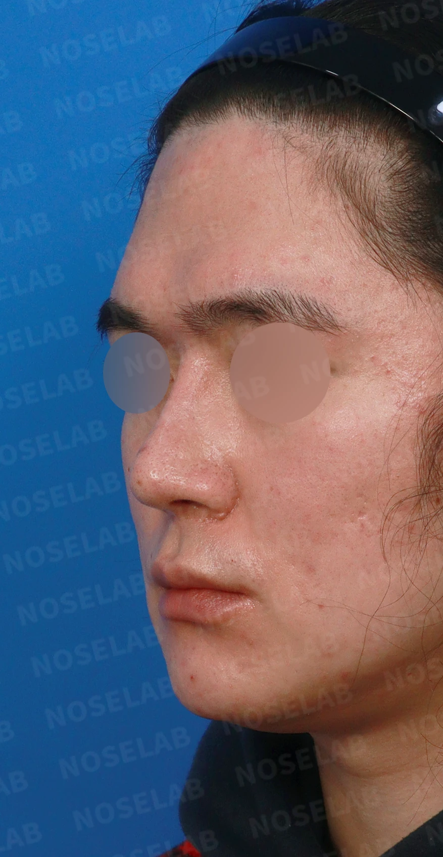콧대를 더 높이고 싶을 때 무엇이 한계를 만드나, 3D 맞춤 보형물과 자가늑연골 코끝 지지 — 디자인 상담 정면, 좌측 측면, 비스듬한 측면 사진입니다.