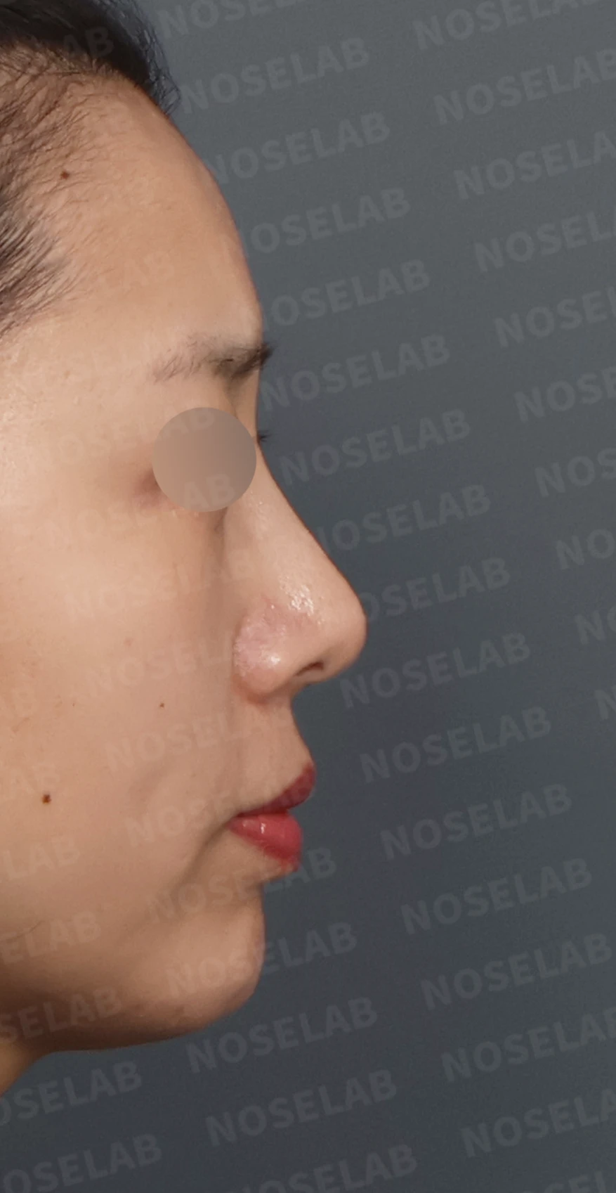 비공 비대칭과 휘어진 코, 자가늑연골 재건으로 교정한 코재수술 — 디자인 상담 우측 측면, 비스듬한 측면, 비공 사진