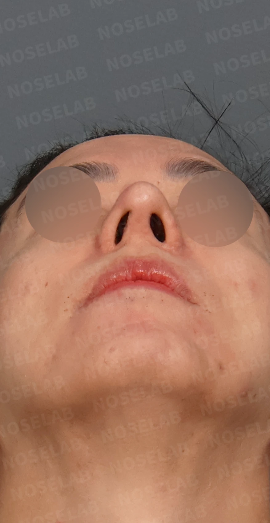 코재수술과 코막힘 교정, 기능과 심미 모두 잡은 비개방 코성형 사례 — 디자인 상담 우측 측면, 비스듬한 측면, 비공 사진입니다.