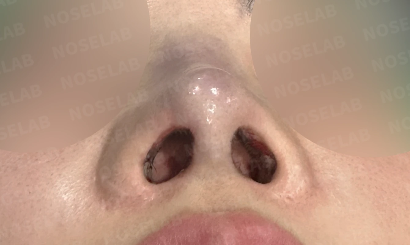 여러 차례 코 수술 뒤 내부 구조가 무너지는 이유와 늑연골 전체 재건 — 수술 직후 0일 비공 사진입니다 직후 사진은 부기가 있는 상태로 최종 결과와 다를 수 있습니다.