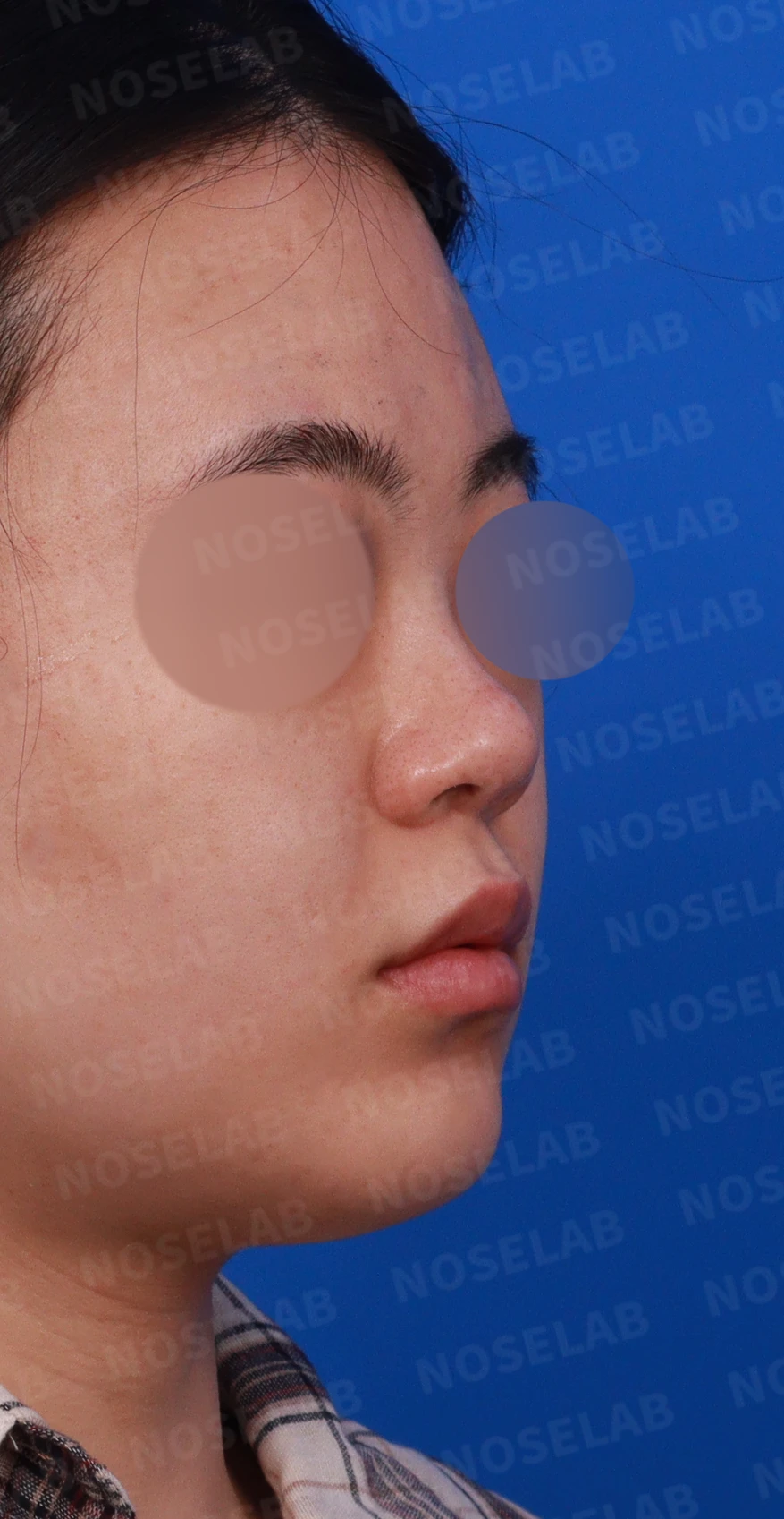코끝 피부가 두껍고 잘 늘어나지 않는 코에서 높이와 직반 라인을 만드는 방법 — 디자인 상담 우측 비스듬한 측면, 측면, 비공 사진